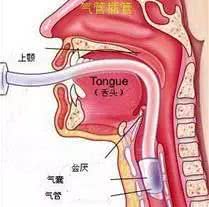 为气管插管患者置胃管难度大？不妨试试这个技巧，屡试不爽