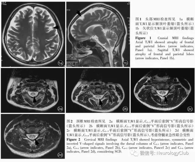 临床案例：滥用笑气中毒致神经系统损害一例（一氧化二氮，N2O）