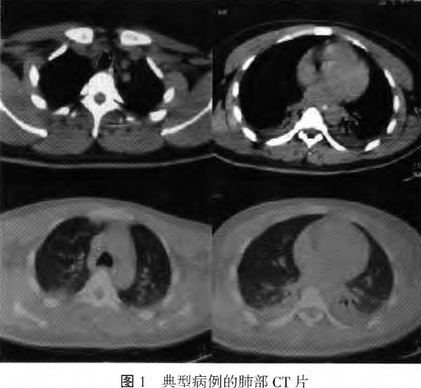 急性乙草胺中毒七例临床分析