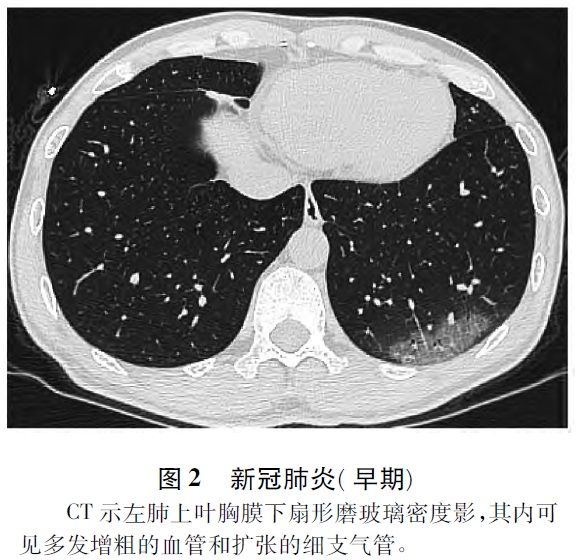 新型冠状病毒肺炎影像诊断指南(2020年第二版简版)