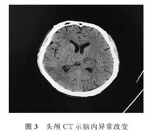 硫化氢气体中毒致迟发性脑病1例