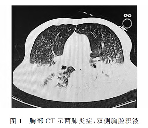 硫化氢气体中毒致迟发性脑病1例